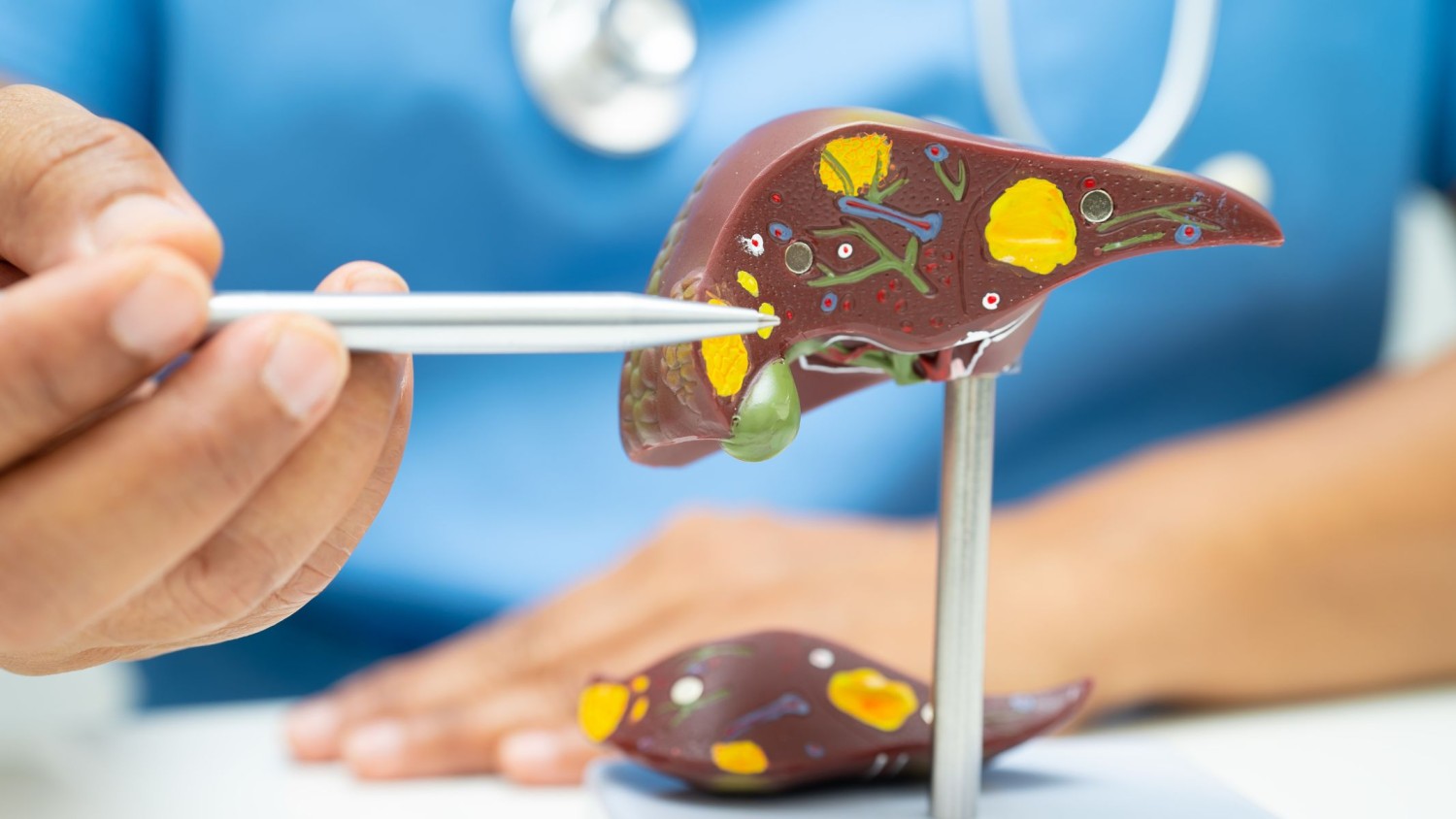 Siêu âm gan nhiễm mỡ: Hình ảnh, chẩn đoán và những điều cần biết